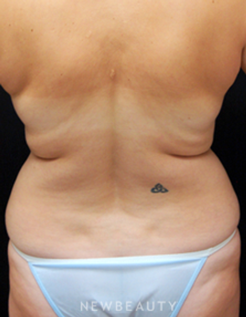 Dr. Mokhtar Asaadi - VASER Lipo - Before