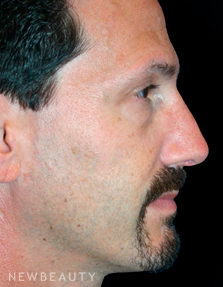 Dr. Kelly Bomer Rhinoplasty - After