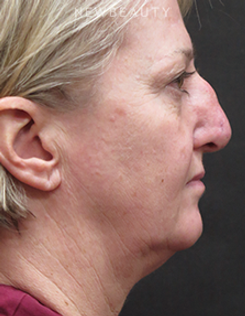 Dr. Elie Levine - Necklift & Rhinoplasty - Before