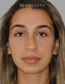 Dr. Anthony Bared - Rhinoplasty - 46164855 - After