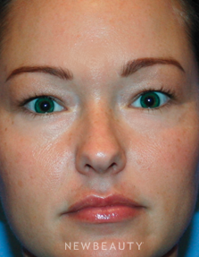Dr. Kelly Bomer - Upper Blepharoplasty - Before