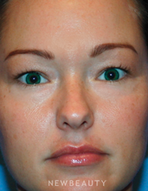 Dr. Kelly Bomer - Upper Blepharoplasty - Before