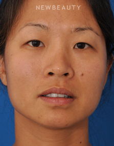 Dr. Edward Kwak - Upper Blepharoplasty - Before