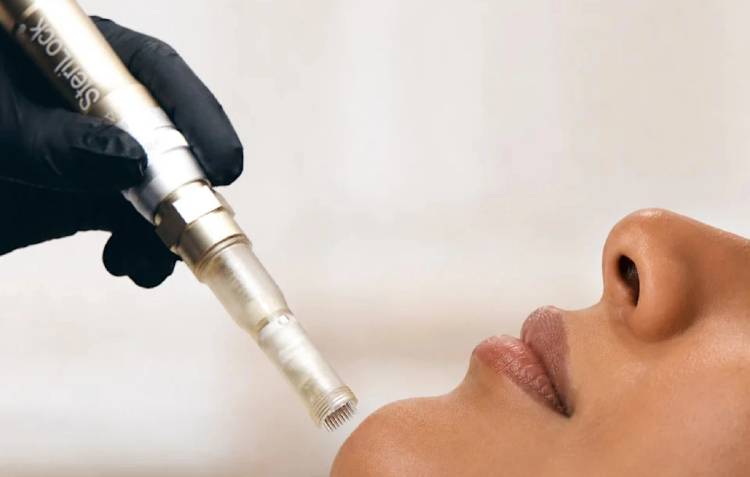 A gloved hand holds a SteriLock microneedling device close to a woman's lower face as she tilts her chin upward, mid-treatment.