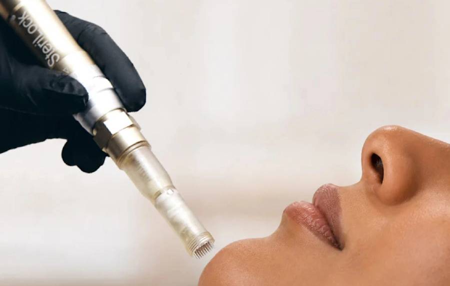 A gloved hand holds a SteriLock microneedling device close to a woman's lower face as she tilts her chin upward, mid-treatment.