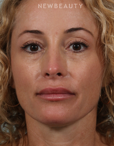 Dr. Kenneth R. Beer - Juvéderm - After