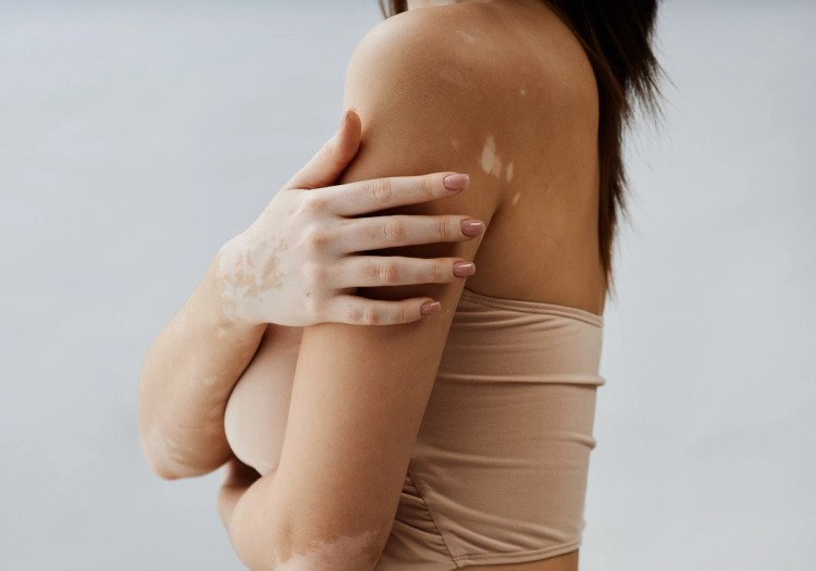 Close-up of a woman’s arm and hand with visible vitiligo patches, wearing a nude tube top against a gray background.