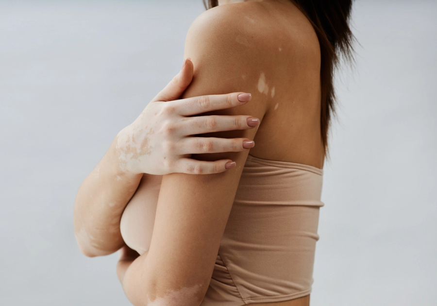 Close-up of a woman’s arm and hand with visible vitiligo patches, wearing a nude tube top against a gray background.