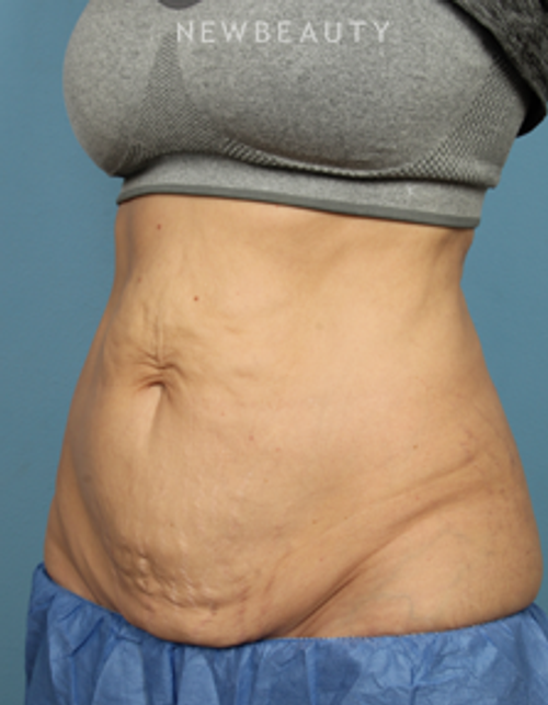 Dr. Kathleen Behr - Emsculpt - Before