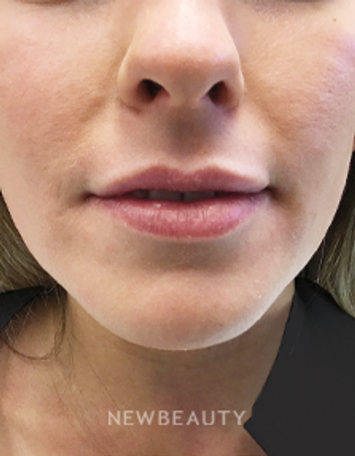 Drs. Elias - Lip Filler - 17150136 - Before
