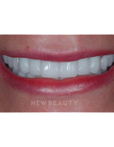 Dr. Guy Lewis Dental Implants - After
