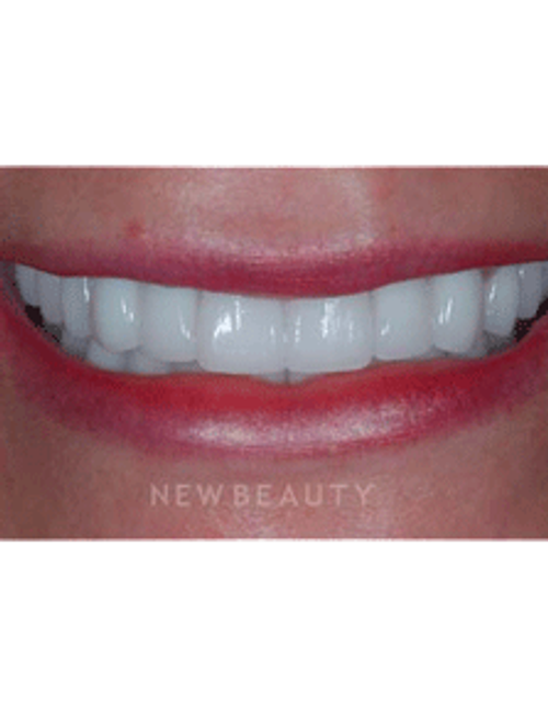 Dr. Guy Lewis Dental Implants - After