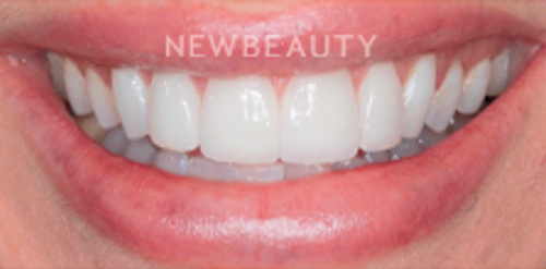 Dr. Victoria Veytsman - Smile Makeover - After