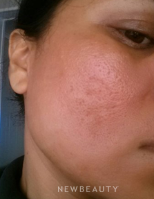 Dr. Jody Levine- Lasers - After