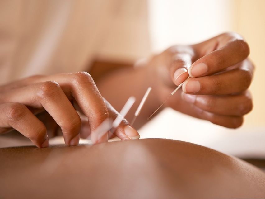 A Beginner’s Guide to Acupuncture