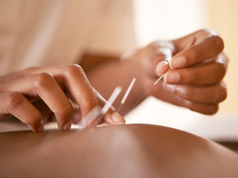 A Beginner’s Guide to Acupuncture