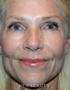 Dr. Kelly Bomer Liquid Facelift - After