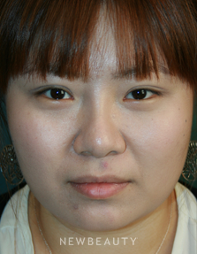 Dr. John Kang - Upper Blepharoplasty & Rhinoplasty - After