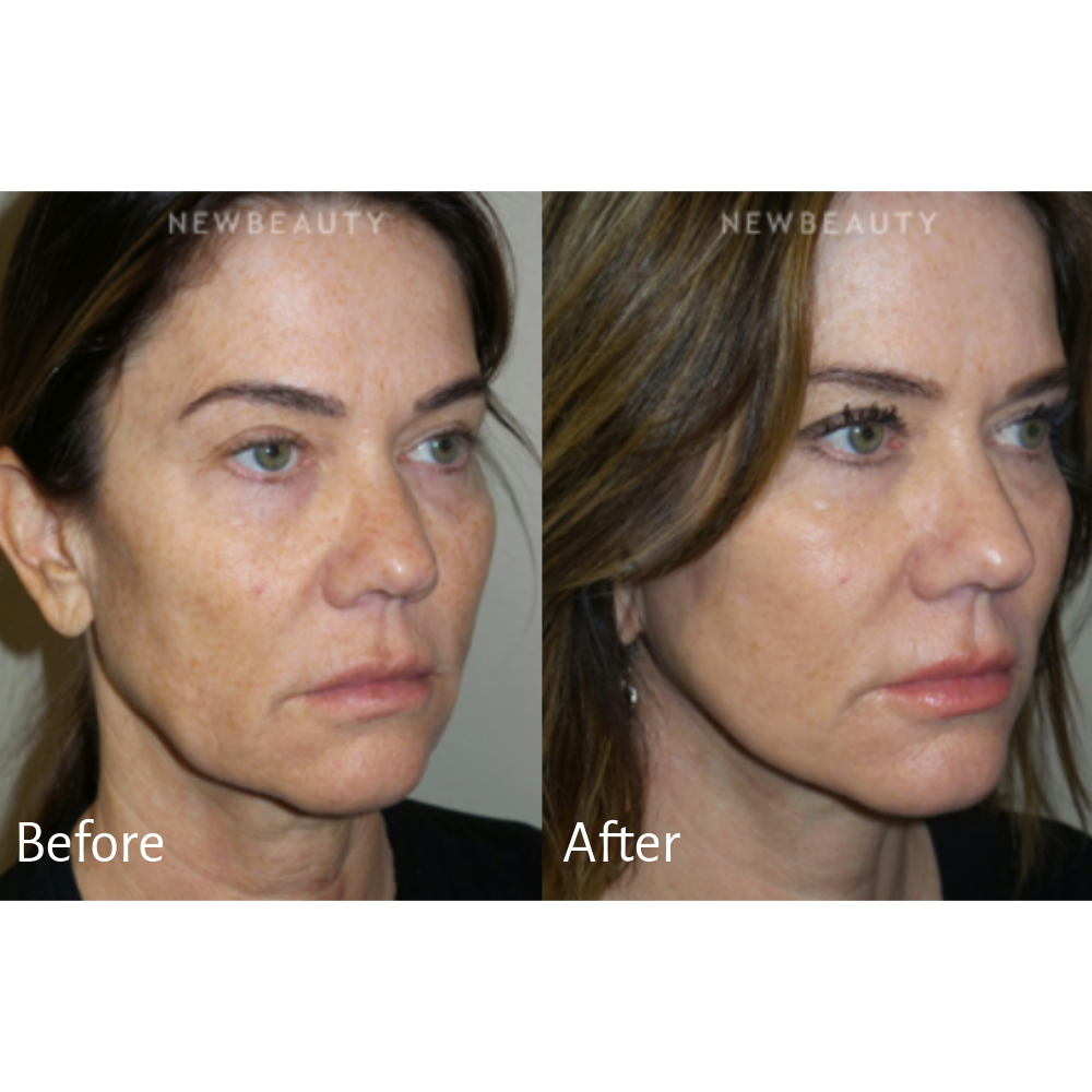 Treatment: Facelift with fat grafting