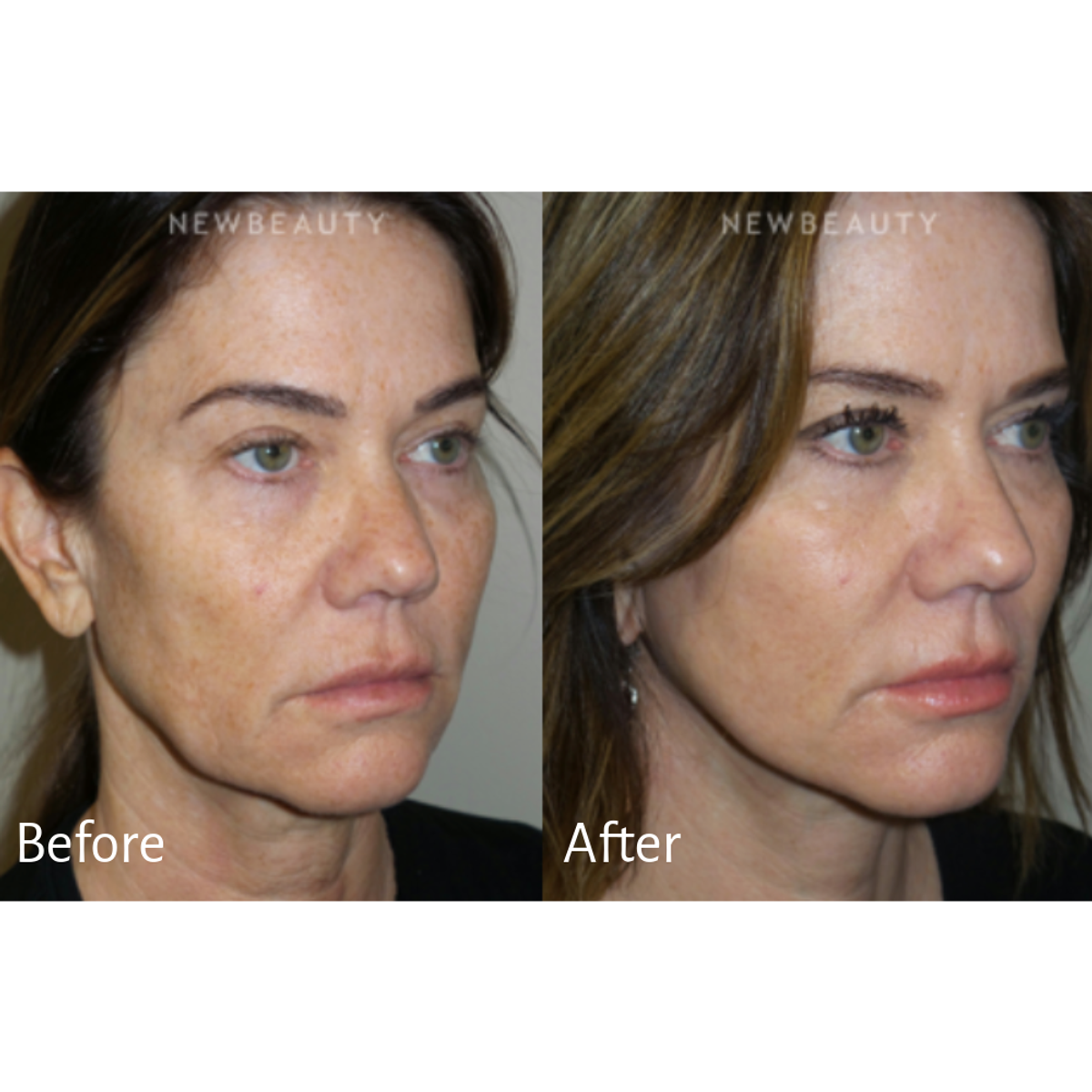 Treatment: Facelift with fat grafting