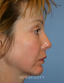 Dr. Kelly Bomer, Facelift - Before