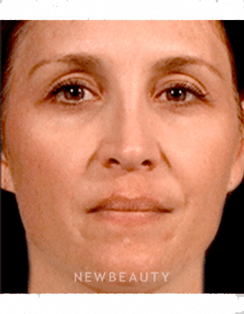 Dr. Alster Tanzi McGregor Lasers - After