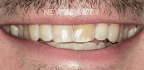 Dr. Salvator La Mastra – Smile Makeover – 46107091 - Before