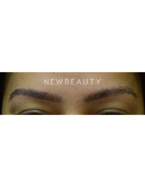 Dr. Jeffrey B. Wise - Eyebrow Hair Restoration - After