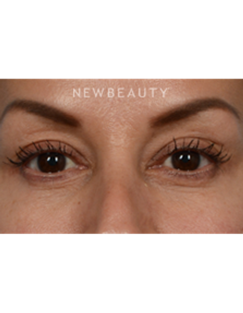 Dr. Jeffrey Wise - Lower Blepharoplasty - After