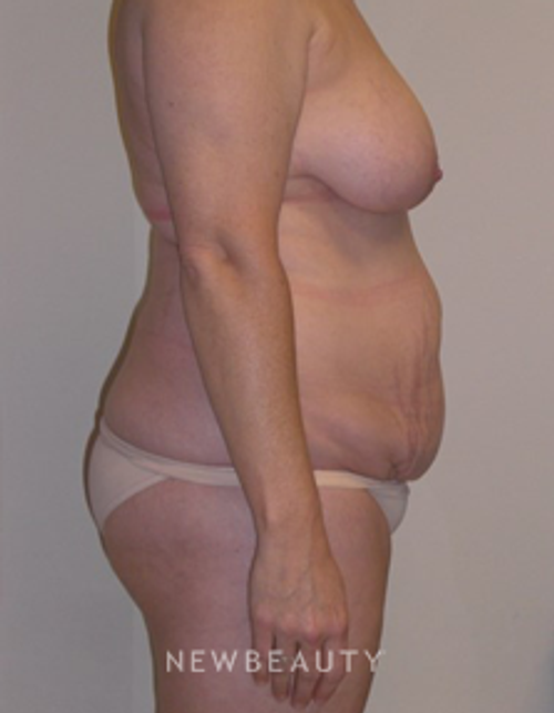 Dr. Carmen Kavali - Mommy Makeover - Before
