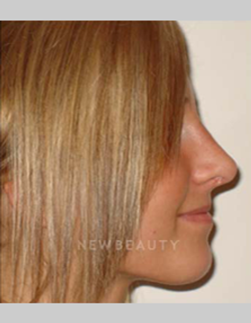 Dr. Michael Horn Rhinoplasty - After