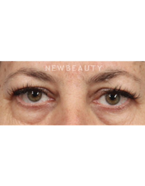 Dr. Kathleen L. Behr - Belotero - Before