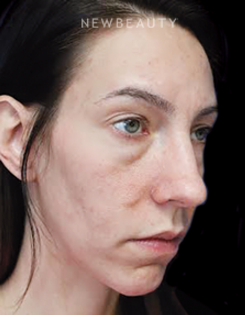 Dr. Joseph Russo - Under-Eye Rejuvenation - Before