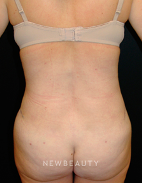 Dr. Mokhtar Asaadi Liposuction Tummy Tuck - After