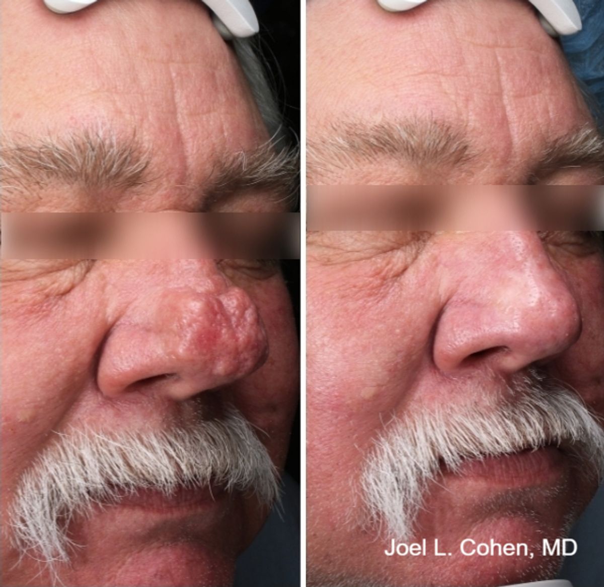 rhinophyma patient before and after, procedure performed by Joel L. Cohen, MD