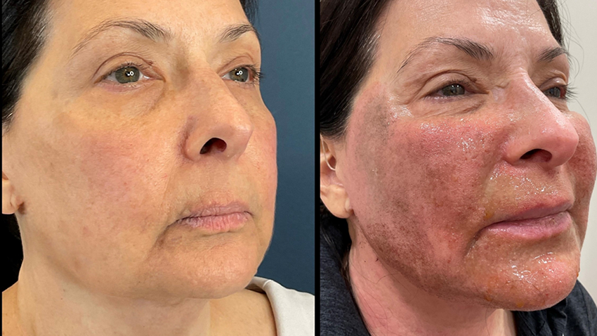 Before and after LaMiNa treatment, Real Patient Stories, Tatiana Bido