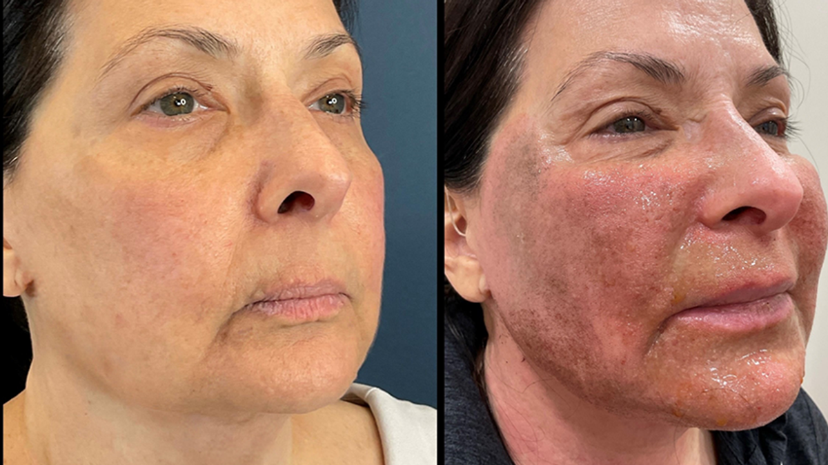 Before and after LaMiNa treatment, Real Patient Stories, Tatiana Bido