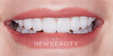 Dr. Nathan Hoffman - Gum Lift, Teeth Whitening & Veneers - After