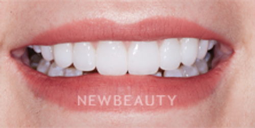 Dr. Nathan Hoffman - Gum Lift, Teeth Whitening & Veneers - After