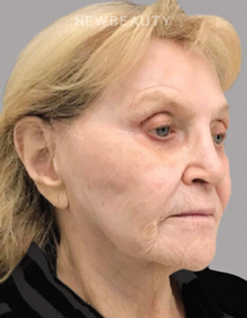 Dr. Janet Allenby - Nonsurgical Skin Tightening - After