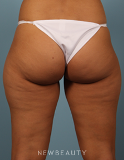 Dr. Carmen Kavali - Velashape - Before