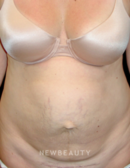 Dr. Mokhtar Asaadi Tummy Tuck, Liposuction - Before
