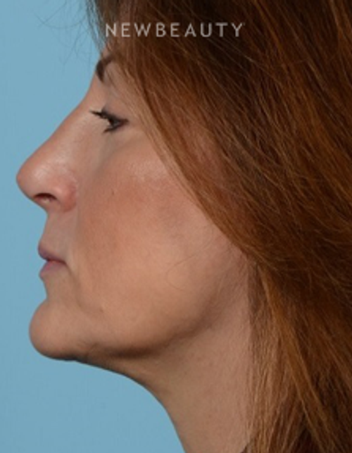 Dr. Jeffrey Wise - Rhinoplasty - After