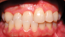 Dr. Joseph Field - Veneers - 20258382 - Before