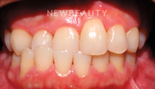 Dr. Joseph Field - Veneers - 20258382 - Before
