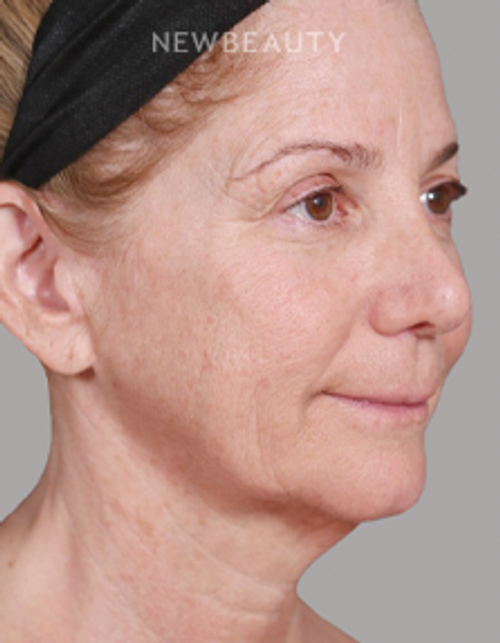 Dr. Paul Nassif - Facelift, Necklift & Browlift - 51350914 - Before