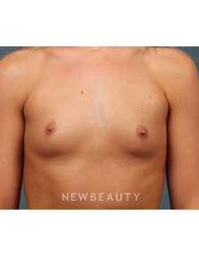 Dr. M. Bradley Calobrace - Breast Augmentation - Before