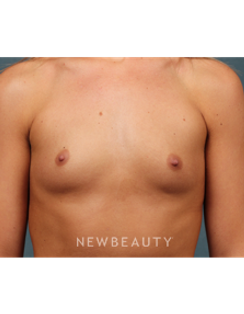 Dr. M. Bradley Calobrace - Breast Augmentation - Before