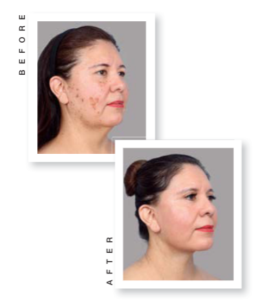 woman facelift before and after