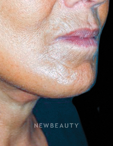 Dr. Roman Rayham - Facelift - After